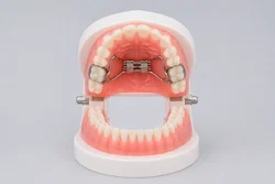 Disjoncteur palatin denture temporaire